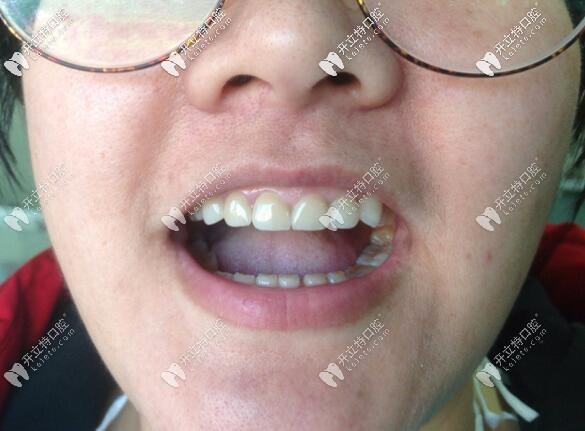 唐山誠(chéng)品口腔牙貼面真人案例