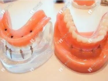 活動假牙可以換購種植牙是真的