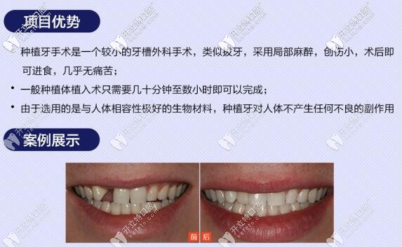 種植牙優(yōu)勢