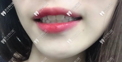 矯正后的效果圖，略微有點(diǎn)內(nèi)頃