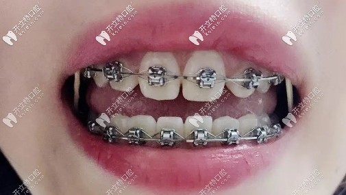 左右各一根橡皮筋，收縫