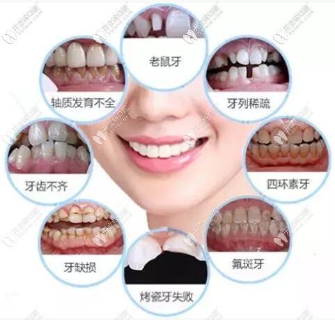 經(jīng)歷2次修復(fù),說說做完瓷貼面的真實感受,有后悔,也有驚喜