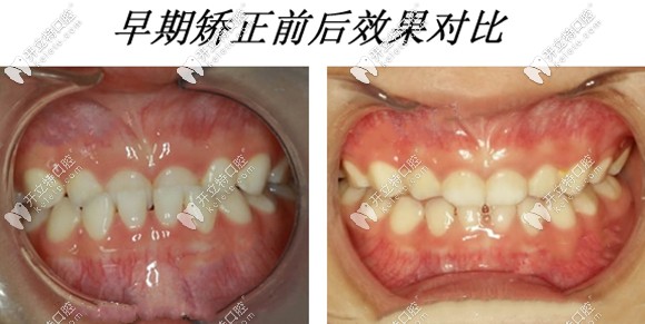 早期干預(yù)矯正的效果圖對(duì)比