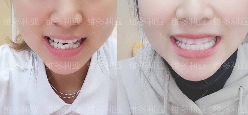 門牙外翻在杭州做隱適美隱形矯正已10個月,效果肉眼看可見