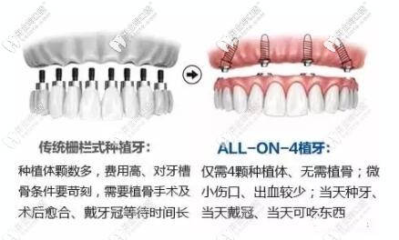 All-on-4種植牙 All-on-4種植牙