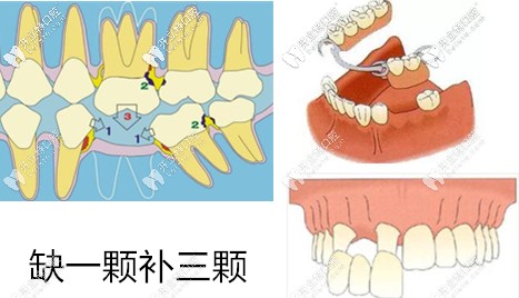 缺牙危害 缺牙危害