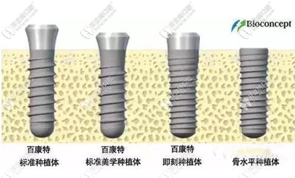 國產(chǎn)百康特種植體