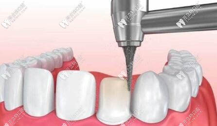 貼面?zhèn)溲? border=