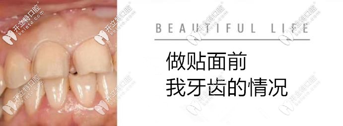 做貼面前的牙齒情況