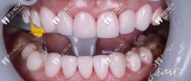 昆山美奧口腔門診部義獲嘉瓷貼面案例 昆山美奧口腔門診部義獲嘉瓷貼面案例