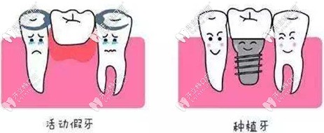 種植牙和活動假牙不同