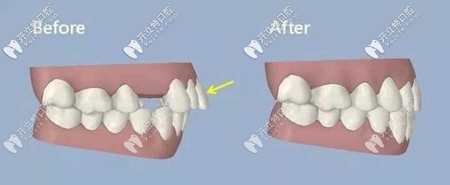 牙齒缺失通過矯正也可以解決