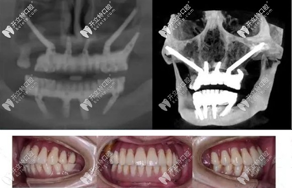 客觀來(lái)說(shuō)做穿顴穿翼板種植牙是利大于弊