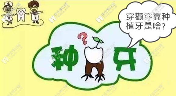 關(guān)于穿顴穿翼板種植牙技術(shù)的風(fēng)險(xiǎn)和效果,你了解多少