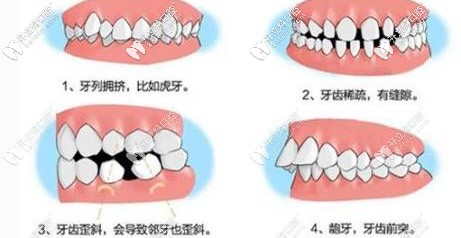 成年人也可以做牙齒矯正