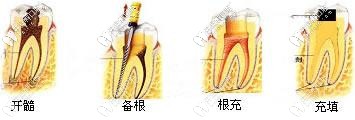 開髓、備根、根充以及填充