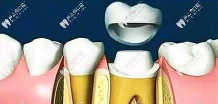 安裝牙冠后完成牙體修復(fù)