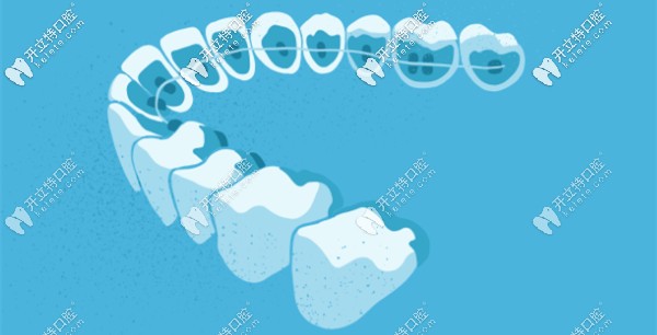 3D隱形矯正的原理
