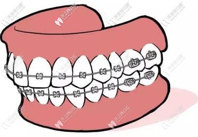 原來傳統(tǒng)鋼絲矯正一副多少錢，跟牙套上的弓絲有關(guān)啊