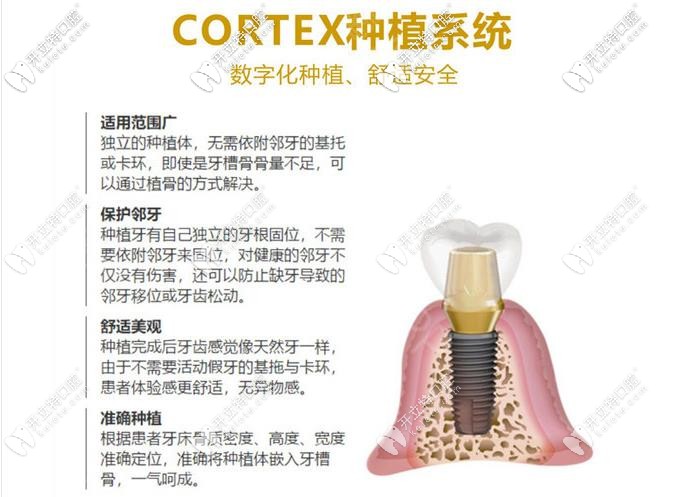 以色列科特斯種植體 以色列科特斯種植體
