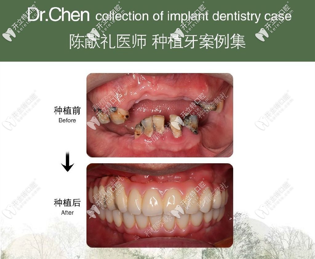 維樂口腔種植牙案例