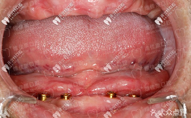 60歲王大爺做allon4全口快速種植牙花了十多萬，兒子卻說……