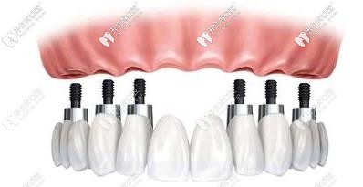 全口種植牙植入6顆植體