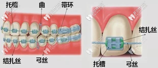 西安美奧口腔傳統(tǒng)金屬托槽牙齒矯正