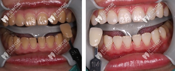 做完一個療程的冷光美白，牙齒色號由5M贈白到1M