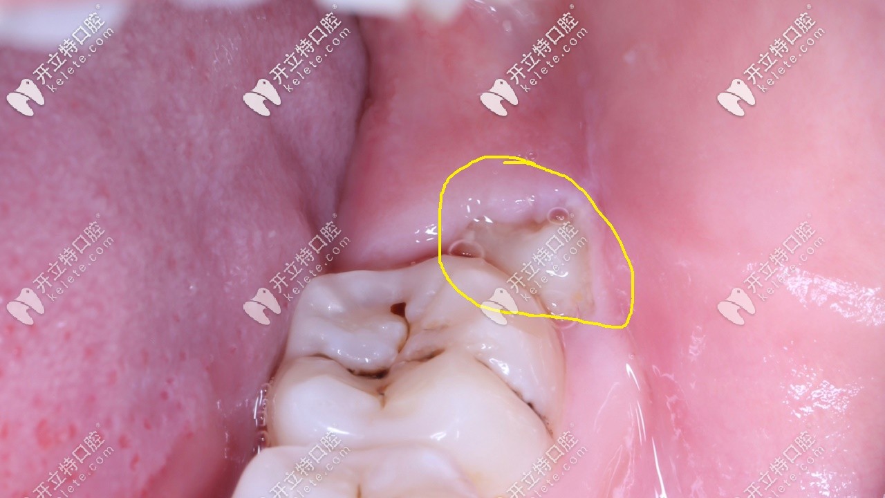 智齒一半長(zhǎng)在肉里經(jīng)常發(fā)炎疼痛,分享拔牙全過程及圖解