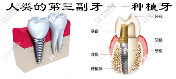 西安美奧口腔免費送種植牙冠