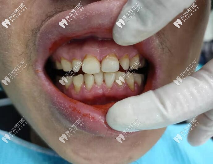 海南海口微笑口腔煙漬牙洗牙真人案 
