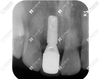 瑞士iti親水BL種植體種植后x片