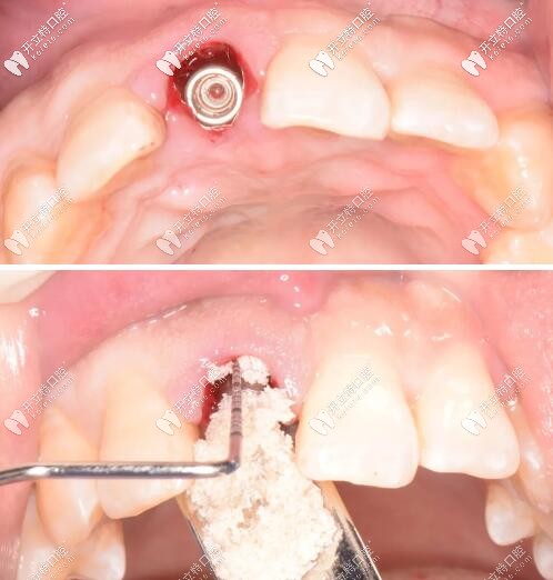 種植牙植入骨粉
