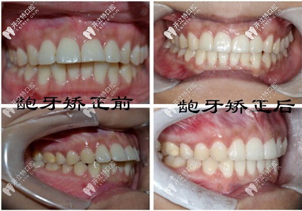 齙牙在海口鼎點(diǎn)口腔做矯正前后對比照片