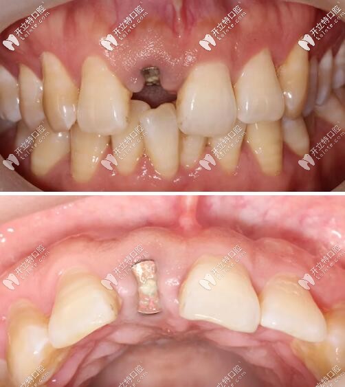 門牙外傷即刻種植牙三個(gè)月后