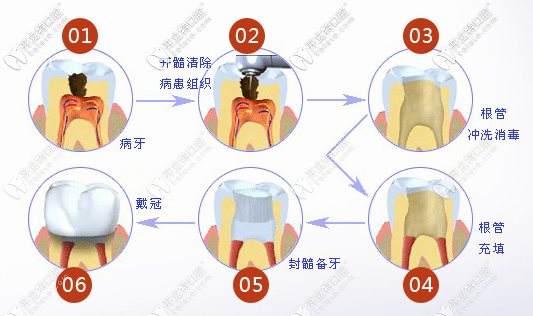 根管治療步驟圖解