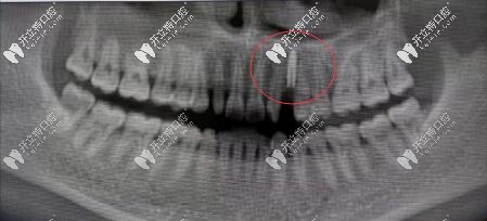 案例:法國安卓健Axiom?2.8mm型號種植體修復(fù)缺失切牙虎牙超贊