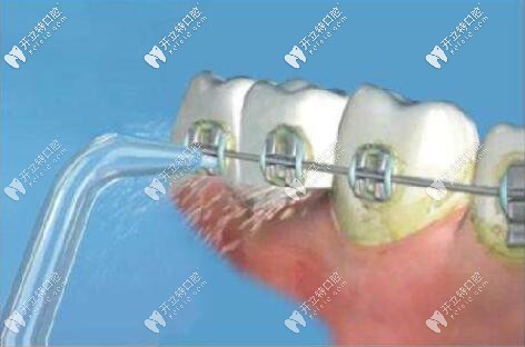 牙周病正畸 牙周病正畸