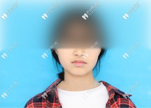 拔4顆牙臉型圖，我覺(jué)得自己臉沒(méi)塌