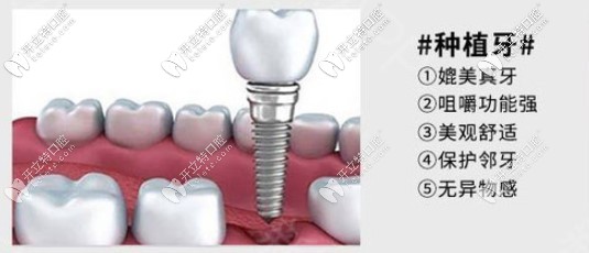 種植牙優(yōu)勢圖