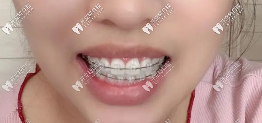 一年牙齒的變化還是蠻大的