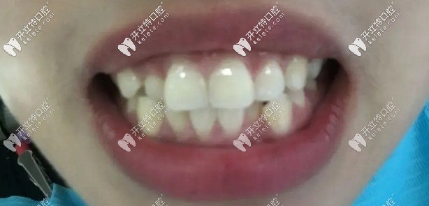 牙列不齊決定做陶瓷矯正