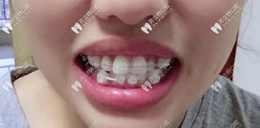 戴陶瓷自鎖托槽中期，牙齒已經(jīng)開始慢慢歸位