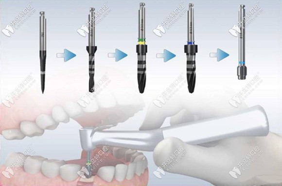 西班牙ticare種植體