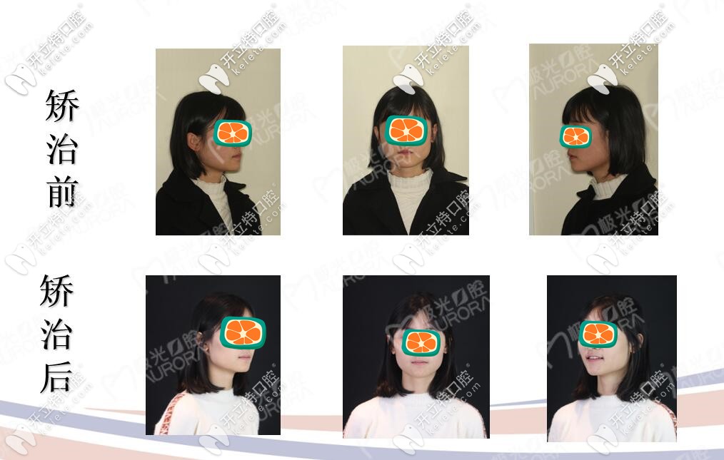 地包天矯正前后對比圖