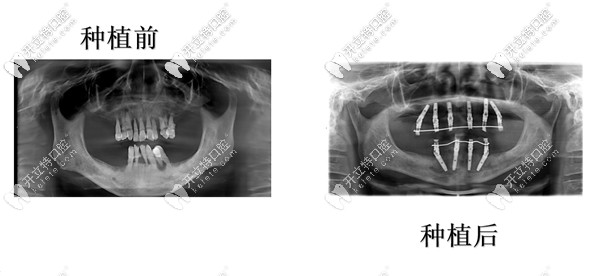 牙周炎全口缺失可以做種植牙嗎 牙周炎全口缺失可以做種植牙嗎