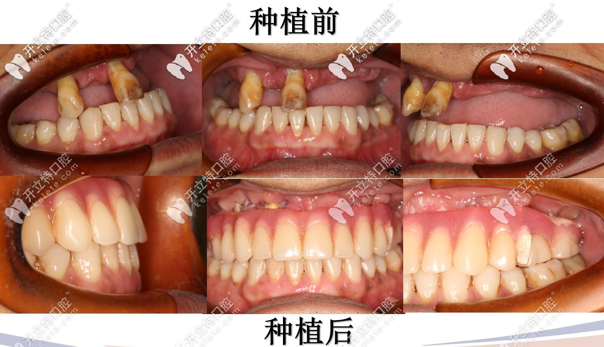 半口種植術(shù)前術(shù)后對(duì)比
