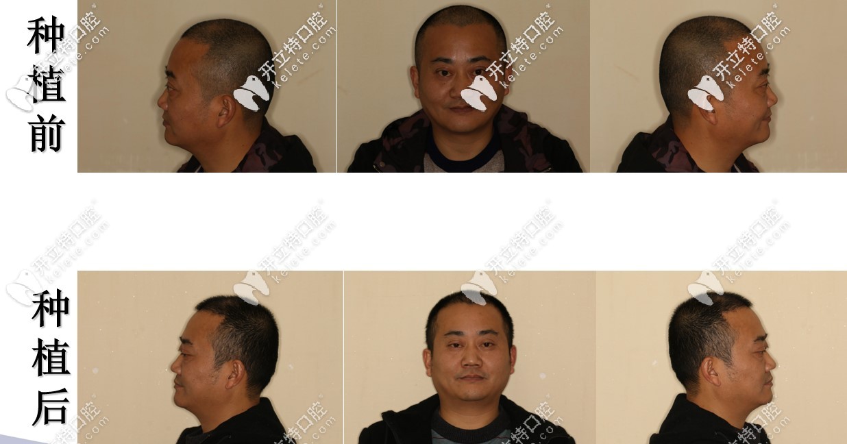 種植牙前后對(duì)比