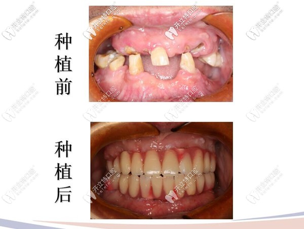 牙槽骨萎縮也能做種植牙 牙槽骨萎縮也能做種植牙